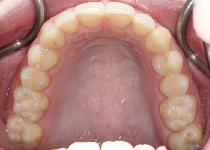 Teeth straightening options