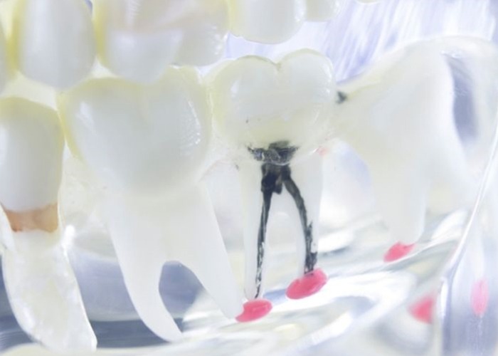 Root Canal Therapy