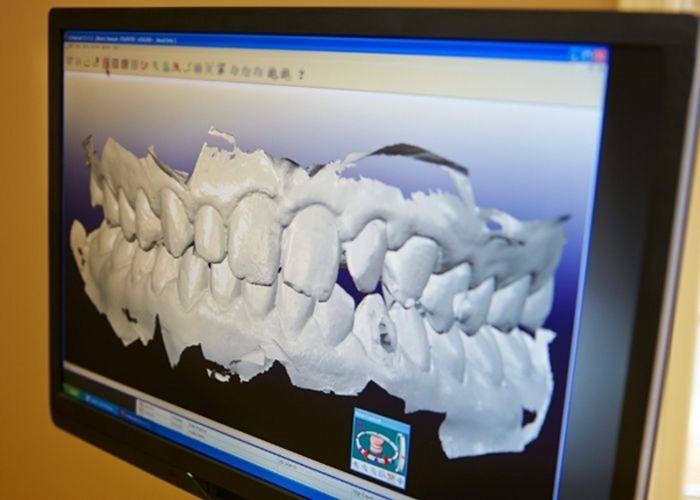 Why Choose a Custom Sports Mouthguard