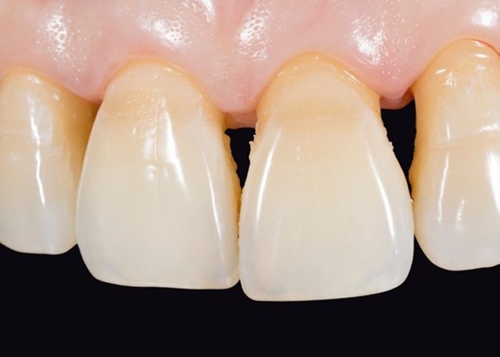Causes of Gum Disease