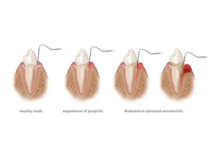 Two Types of Gum Disease