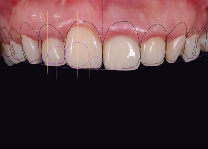 Smile Design