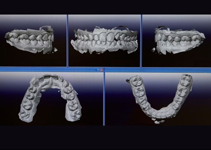 Step 3: Trial Smile and Treatment