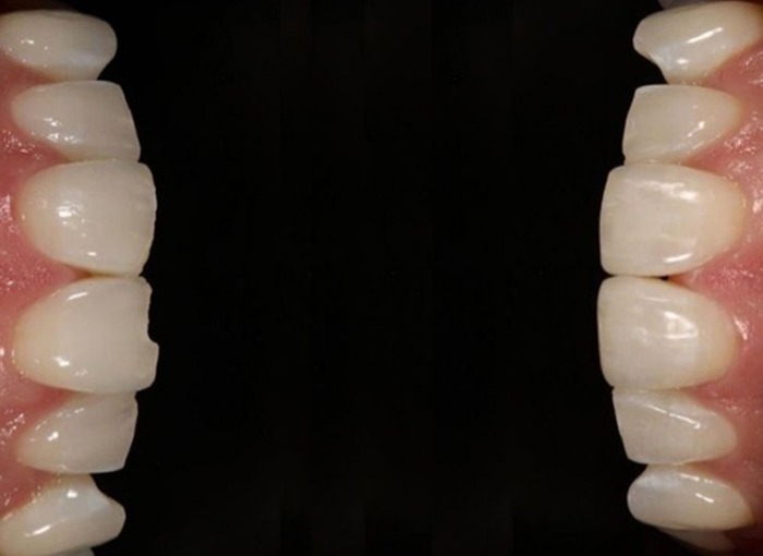 Is Composite Bonding right for me?