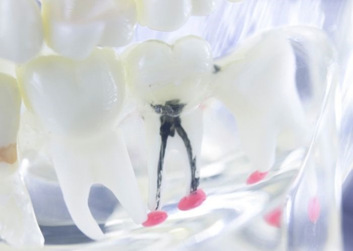 Root Canal Therapy
