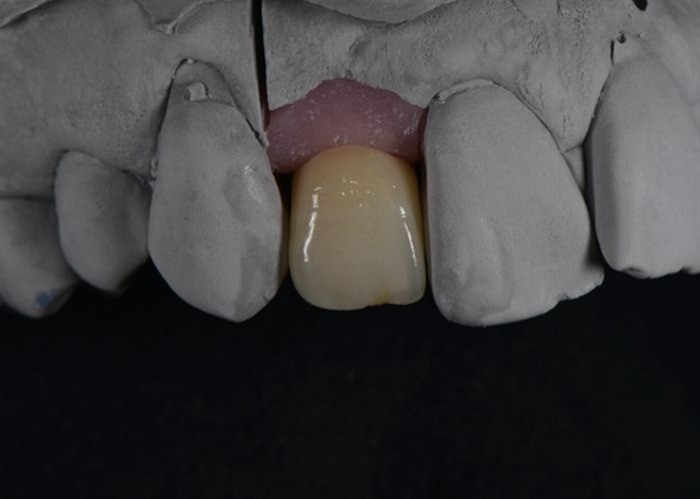 Root canal therapy alternatives