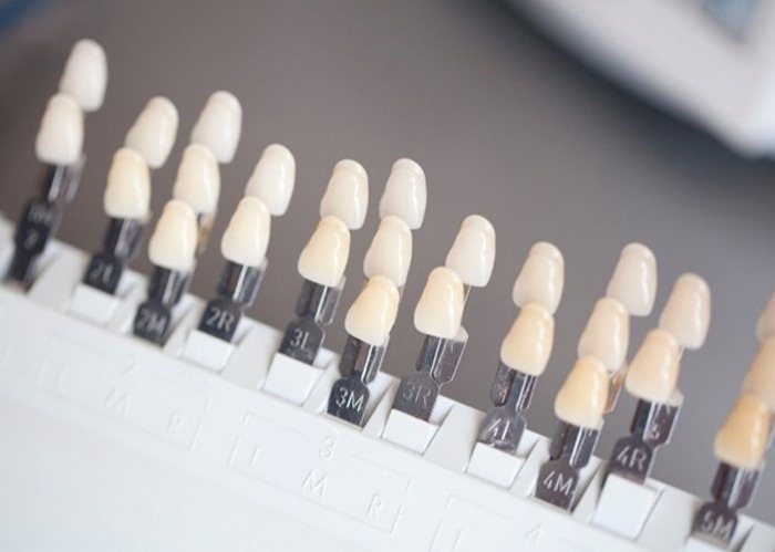 Professional Teeth Whitening