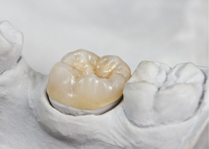 White Fillings in Mount Lawley
