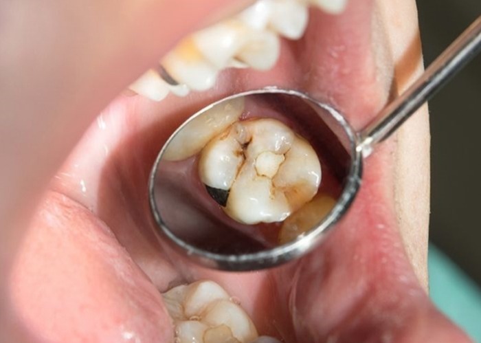 When to Get a White Dental Filling