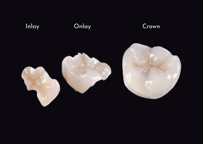 Tooth Filling Alternatives