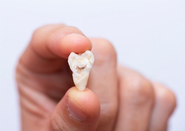 Wisdom Tooth Removal