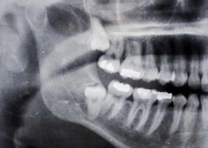 When Wisdom Teeth Need to Go