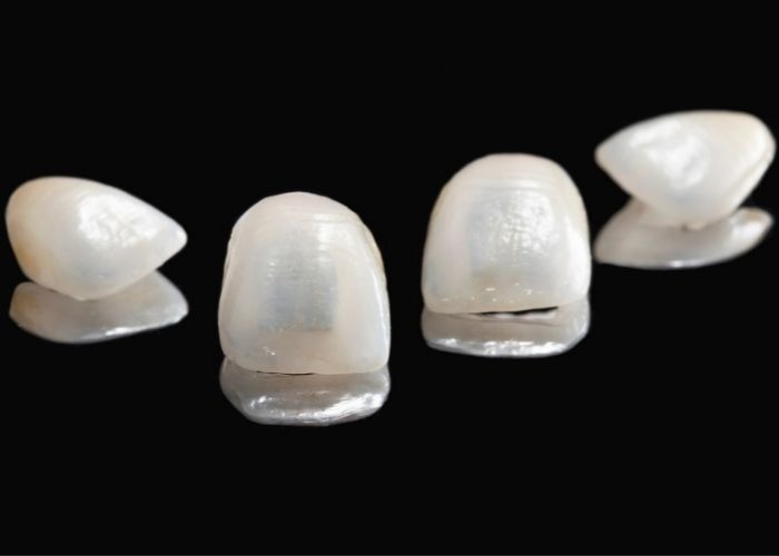 Porcelain Veneers
