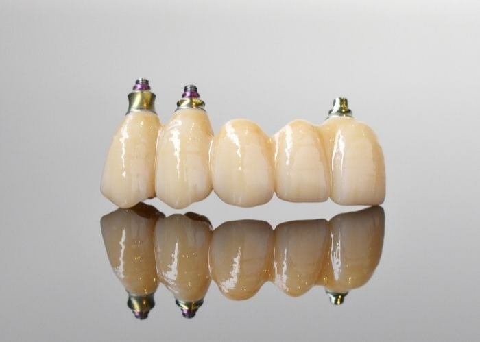 Dental Implants Mount Lawley