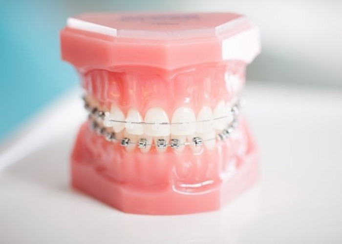 Invisalign vs Braces