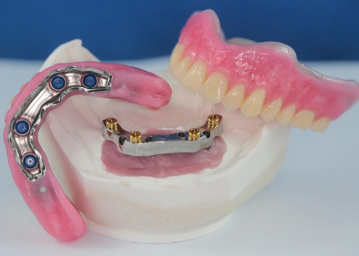 Implant-supported dentures
