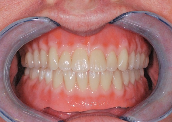Replacing missing teeth