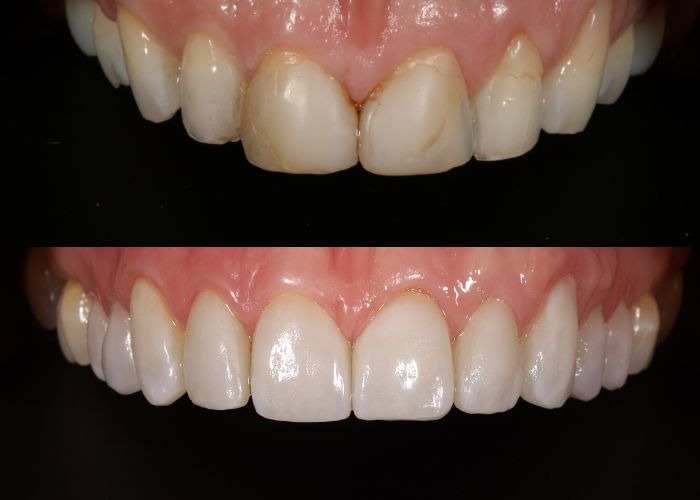 Minor Dental Flaws Be Gone!