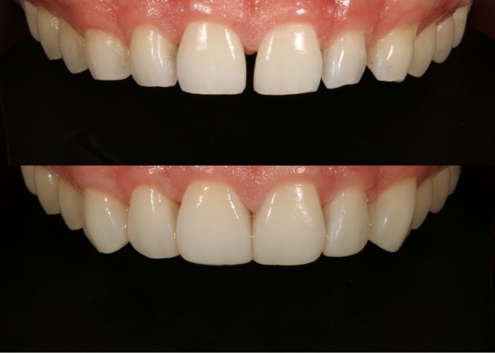 Composite Veneers