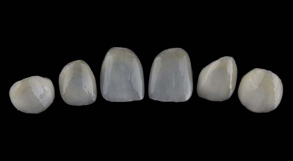 Veneers