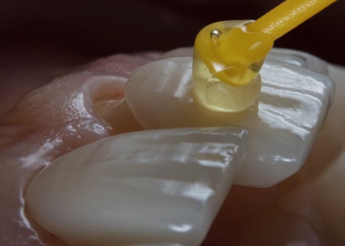 What Are Dental Veneers?