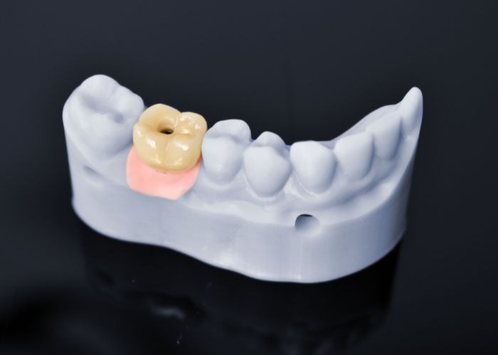 Single Dental Implant Prices From $4641