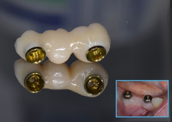 Fixed Implant Bridge from $7,800