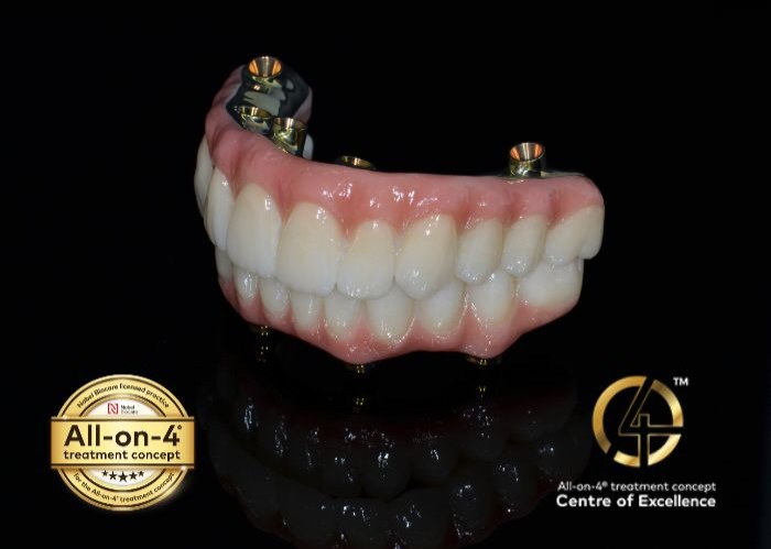 All-on-4® Dental Implants From $21,000 per arch or $40,000 for both