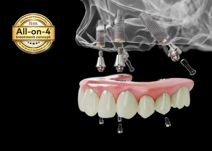 All-on-4® Dental Implants
