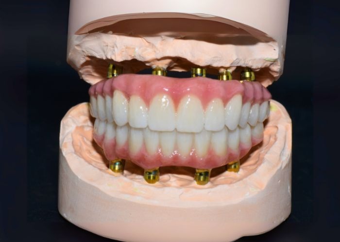 All-on-4® Treatment Costs