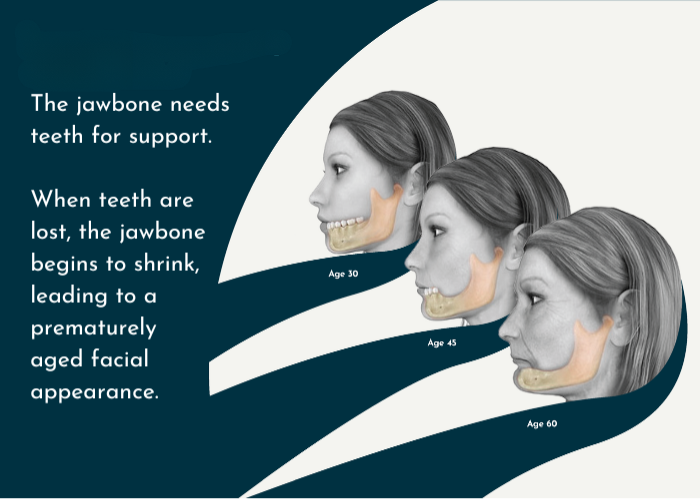Why Consider All-on-4® Dental Implants?