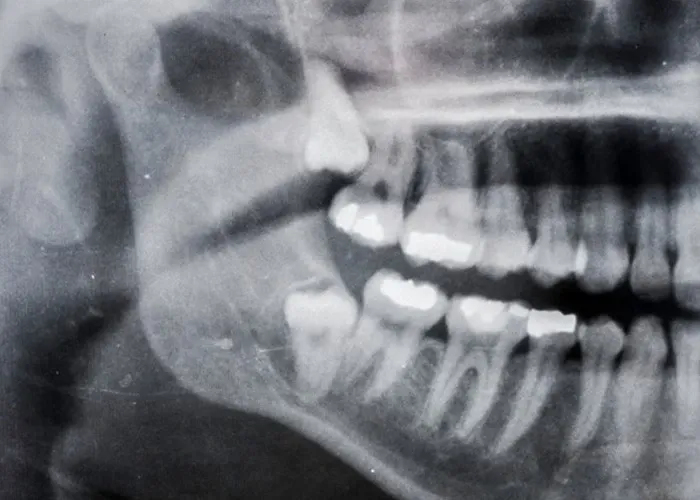 Wisdom Teeth and Other Extractions