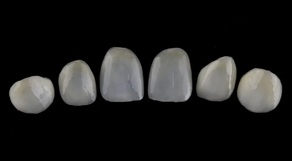 Veneers