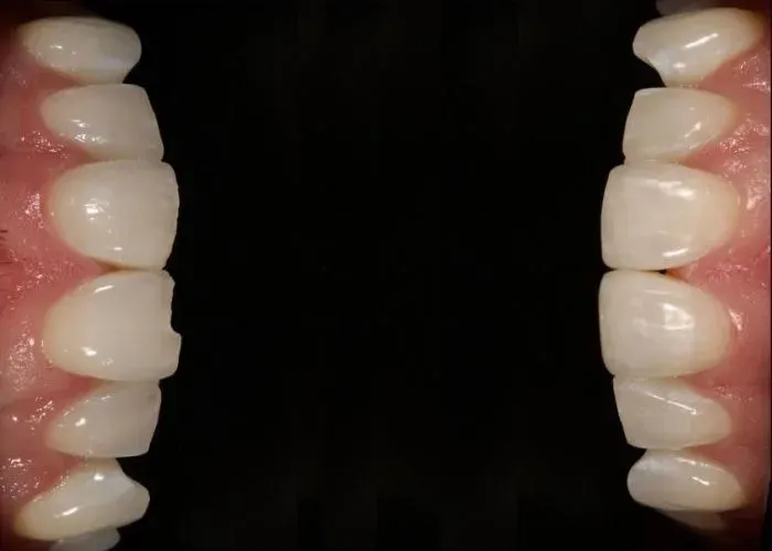 Tooth Bonding