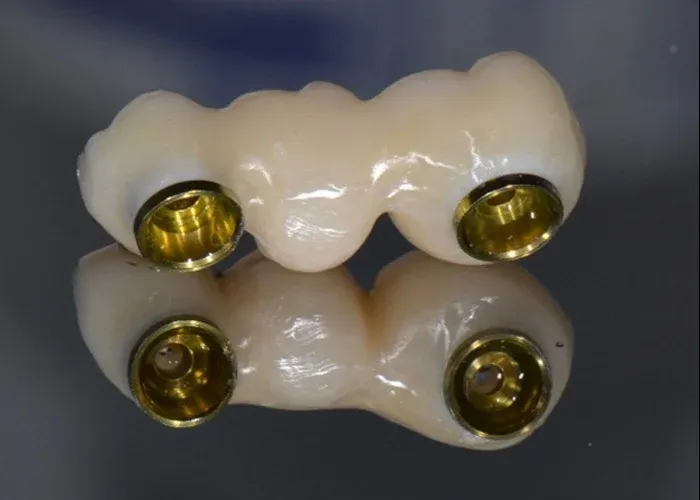 Choosing dental implants