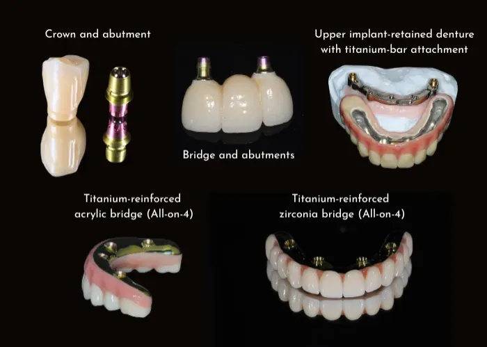 Tooth Materials for Dental Implants