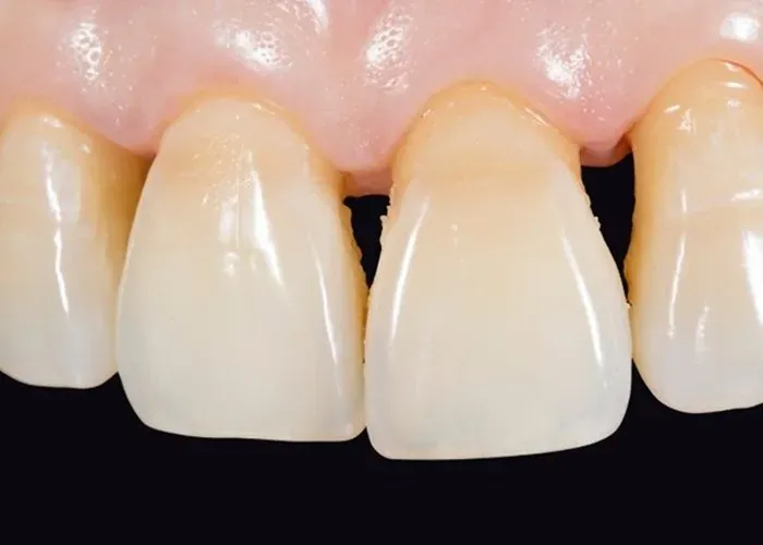 Causes of Gum Disease