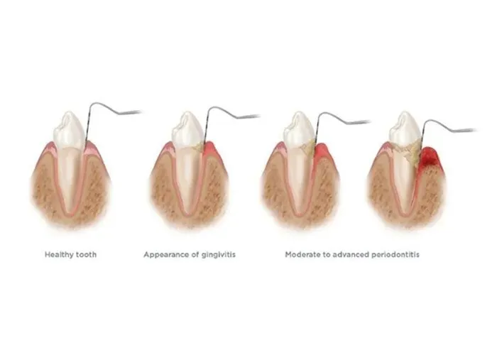 Two Types of Gum Disease