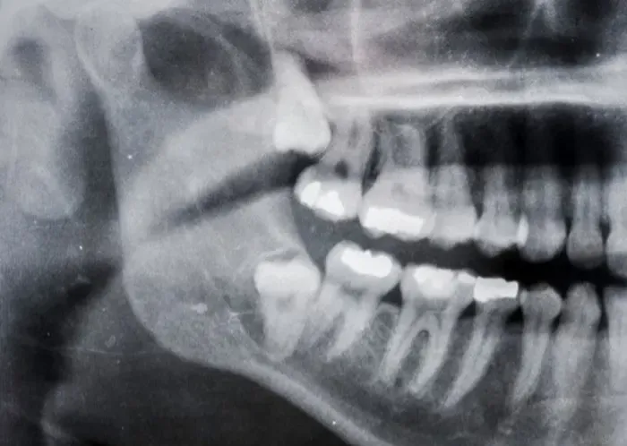 When Wisdom Teeth Need to Go