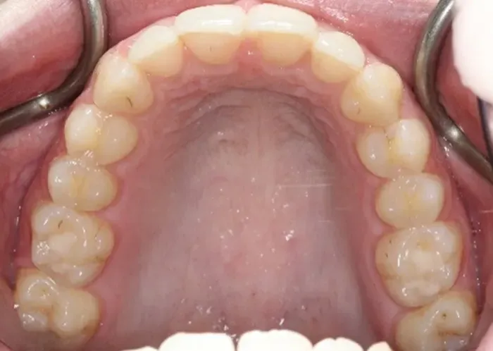 Teeth straightening options