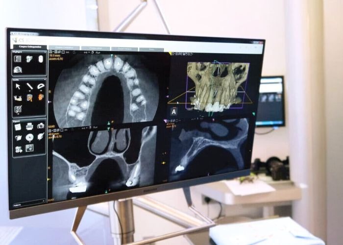 Implant Cost Considerations