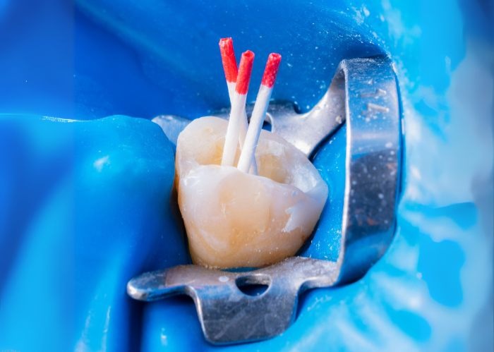 Treatment Risks for Root Canal