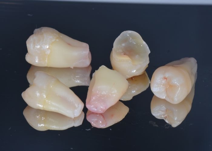 Wisdom Tooth Removal Treatment Risks