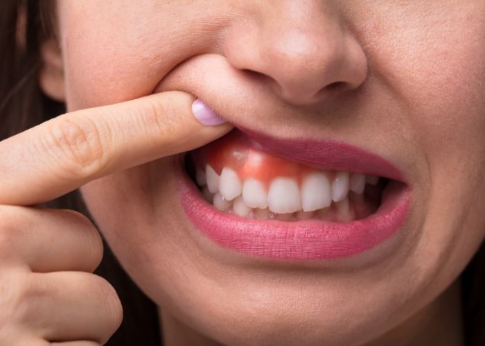 Teeth Whitening Risks