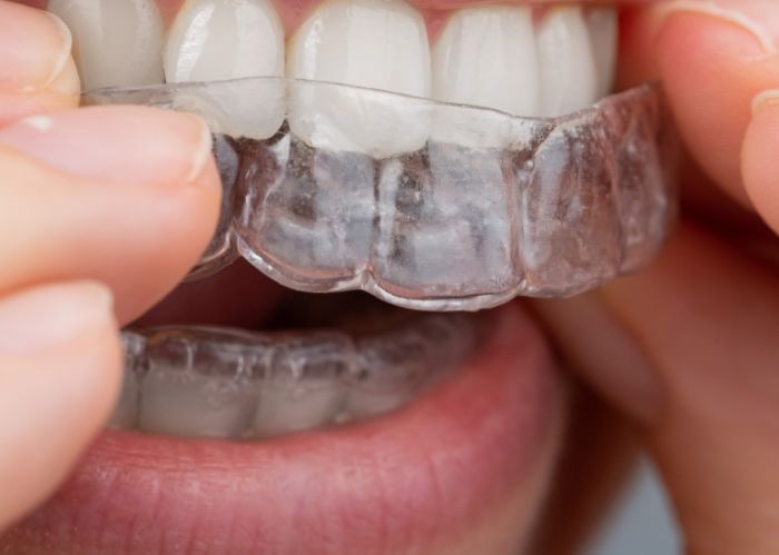 Teeth Straightening Risks
