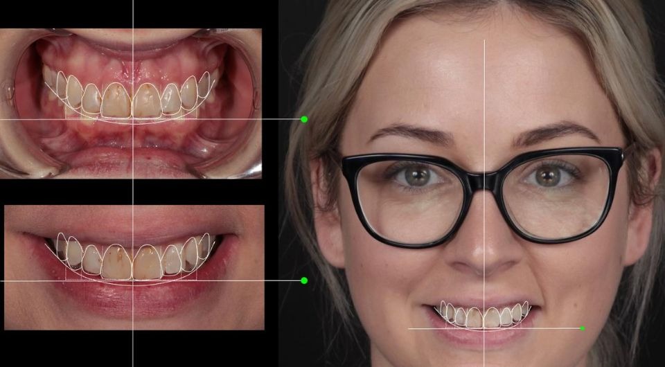 How Long Do Veneers Last?