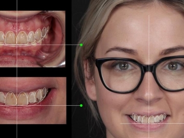 How Long Do Veneers Last?
