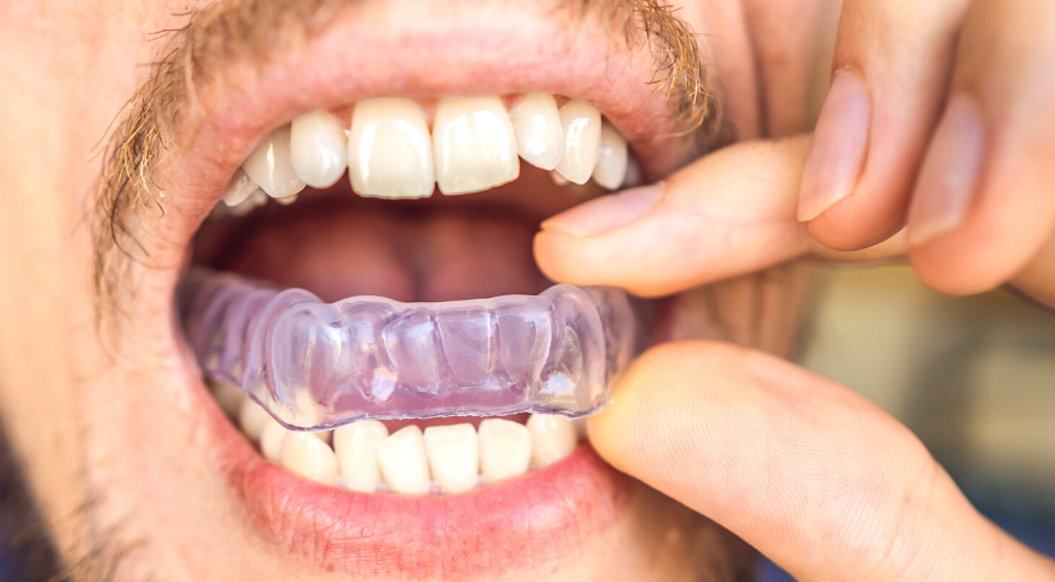6 Reasons to Wear a Custom Mouthguard