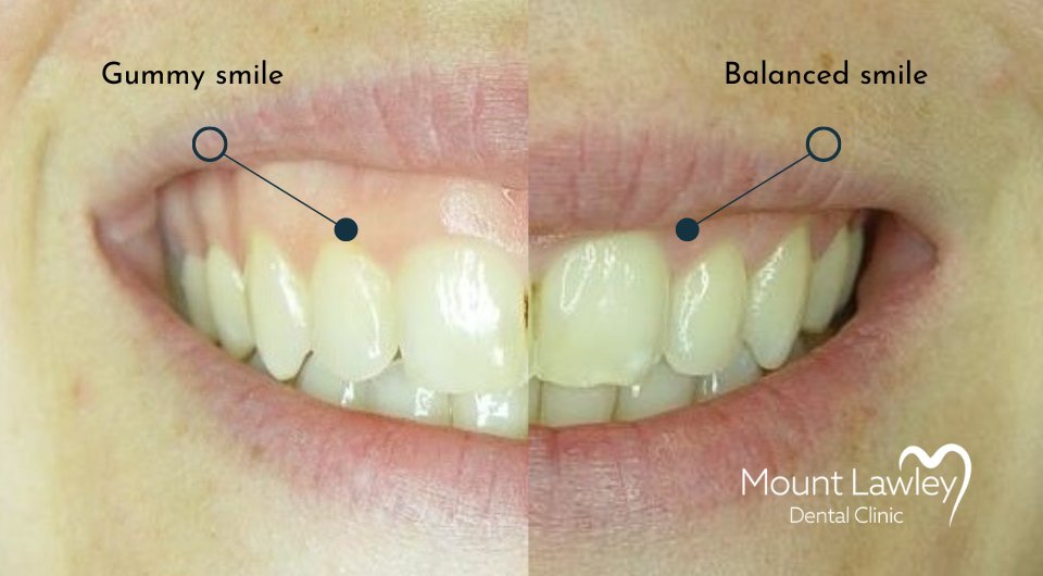Reframing Your Smile - Gum Contouring