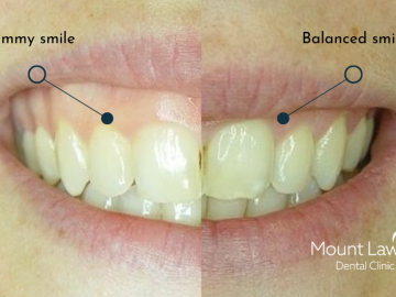 Reframing Your Smile - Gum Contouring